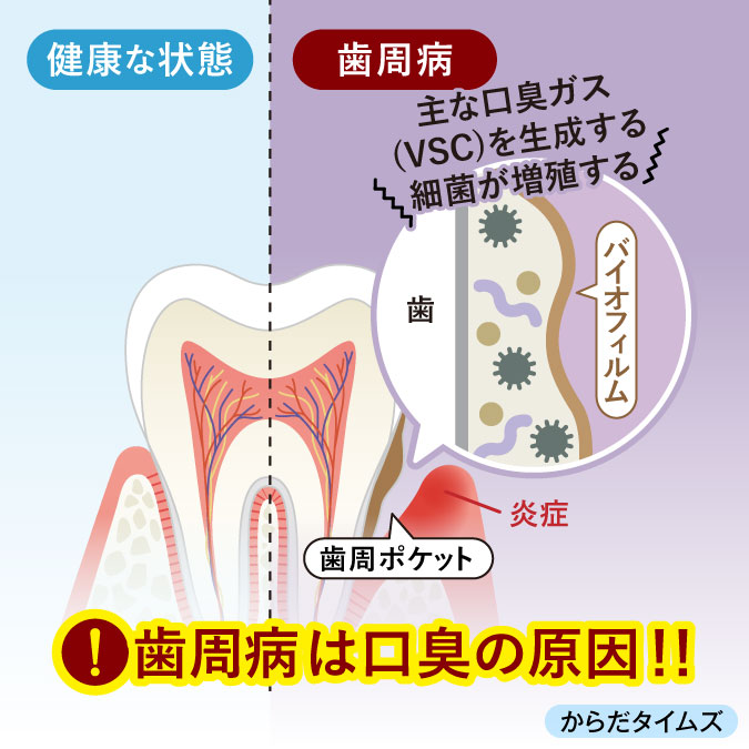 歯周ポケットで細菌増殖